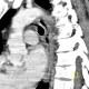 Oesophagitis, corrosive oesophagitis, lye ingestion: CT - Computed tomography
